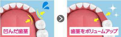 埋入が可能になり、へこんだ歯茎のボリュームも再生できる「GBR法」
