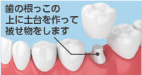 歯の根っこの上に土体を作って被せ物