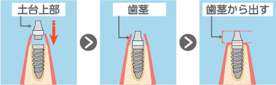 土台・歯茎