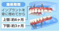 上顎・下顎の施術期間