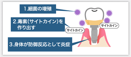 インプラント周囲炎の原因