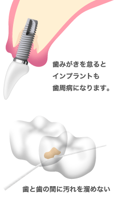 歯磨きを怠ると歯周病になります