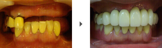 前歯の症例写真