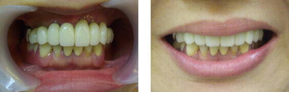 前歯の治療症例写真
