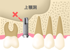 上顎奥歯の場合