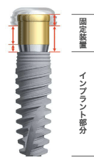 固定装置/インプラント部分