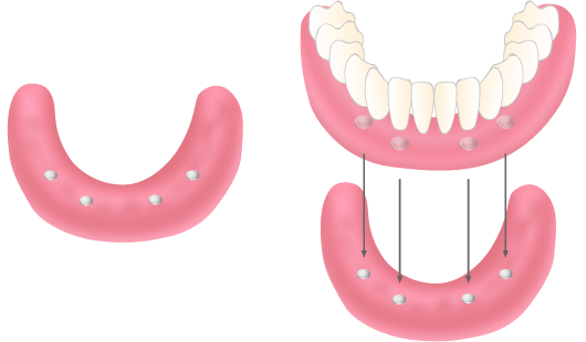 入れ歯を固定するインプラント