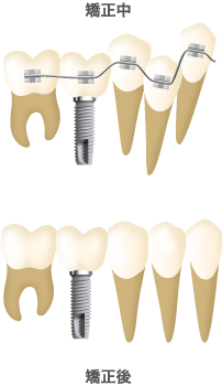 矯正中　矯正後
