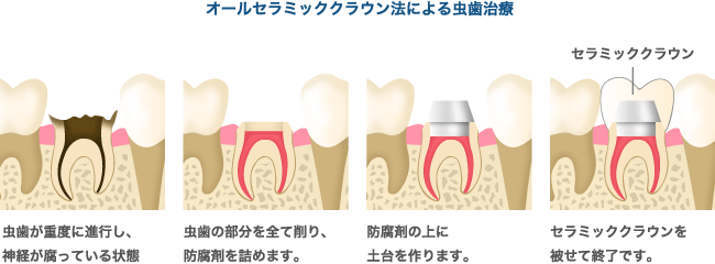 オールセラミッククラウン法による虫歯治療
