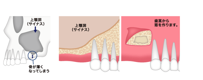 サイナスリフト ステップ01