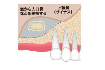 サイナスリフト ステップ02