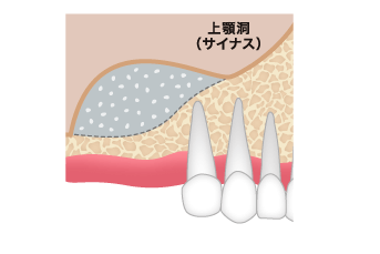 サイナスリフト ステップ03