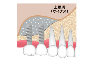 サイナスリフト ステップ04