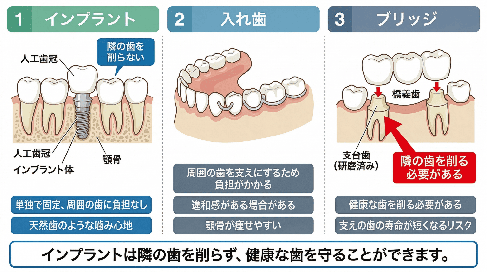 インプラント、入れ歯、ブリッジの構造的な違いの比較