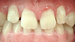 teeth-gap
