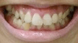 gummy-smile
