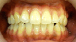 whitening