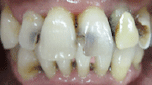 periodontitis