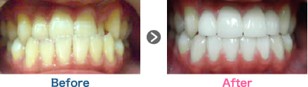 セラミッククラウン法による受け口治療