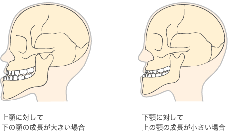 骨格的な発育過剰もしくは発育不全