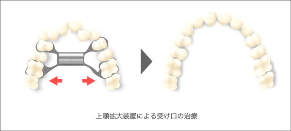 拡大装置による処置