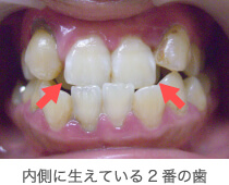 内側に生えている2番の奥