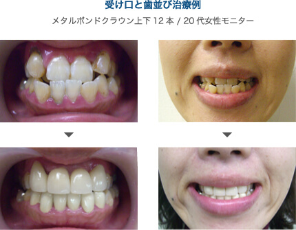 受け口と歯並び治療例