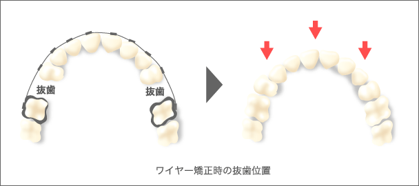 ワイヤー矯正時の抜歯位置