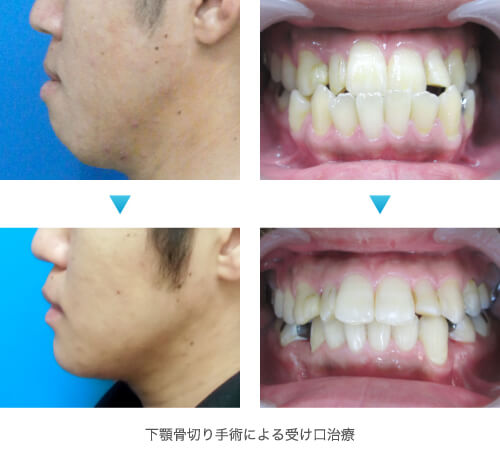 下顎骨切り手術による受け口治療