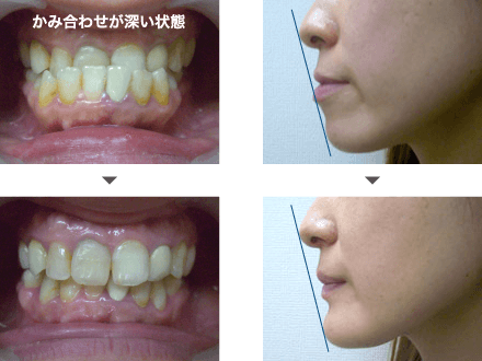 受け口治療の症例