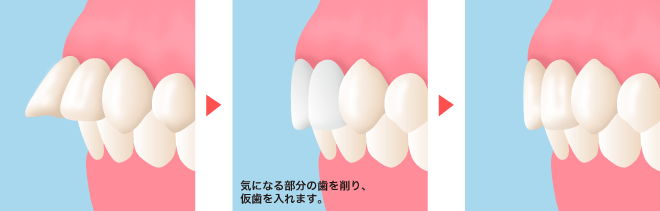 セラミック法による出っ歯の治療法