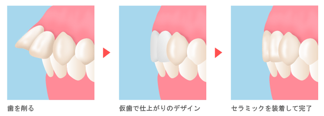 歯科整形で治療する出っ歯矯正（整形）とは