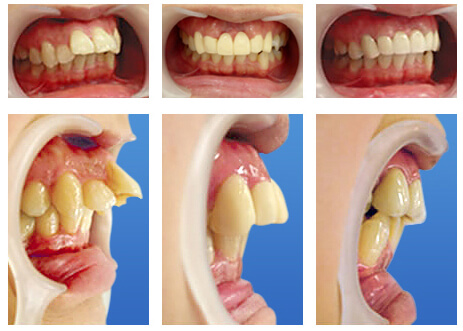出っ歯矯正の流図