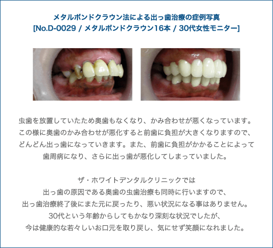 メタルボンドクラウン法による出っ歯治療の症例写真