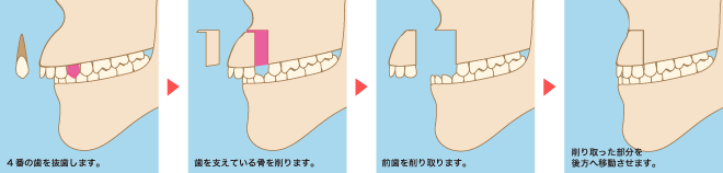 骨格的な出っ歯の治療法
