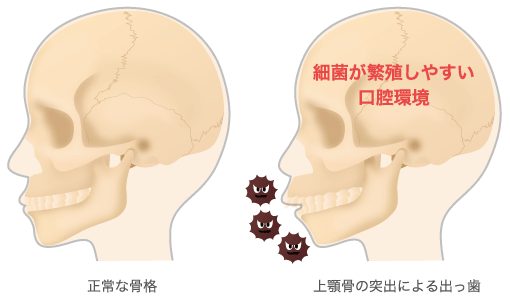 出っ歯で口を閉じづらいのですが