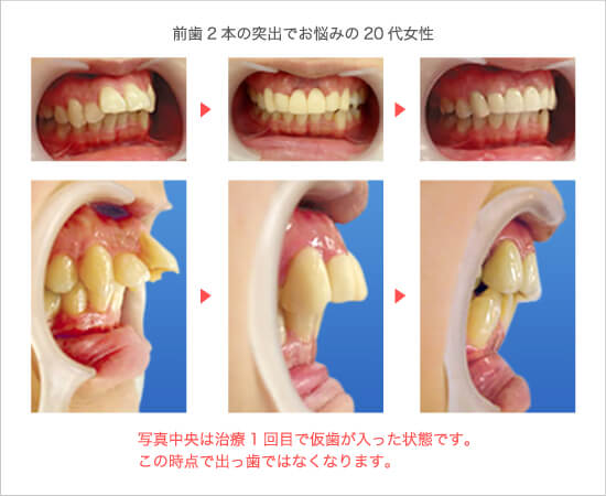前歯2本の突出でお悩みの20代女性
