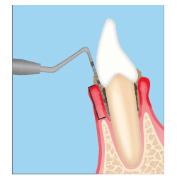 歯周ポケットについて