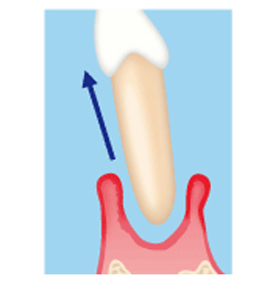 歯槽膿漏との違い