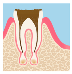 虫歯と歯周病