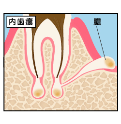 歯肉炎との違いとその関連性