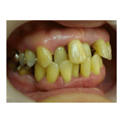 歯並びとの関係