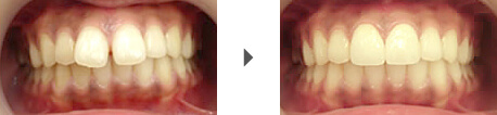 すきっ歯矯正のセラミッククラウン法