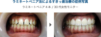 ラミネートベニア法によるすきっ歯治療の症例写真