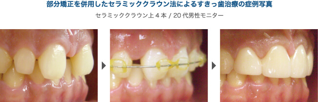 部分矯正を併用したセラミッククラウン法によるすきっ歯治療の症例写真