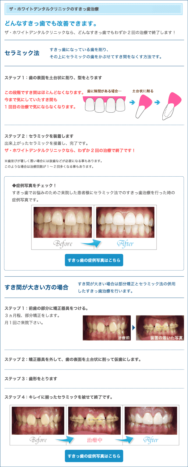 すきっ歯治療
