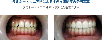 ラミネートべニア法写真