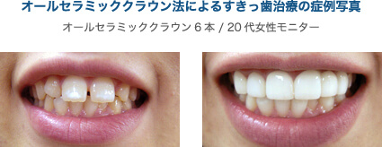 オールセラミッククラウン法によるすきっ歯治療の症例写真