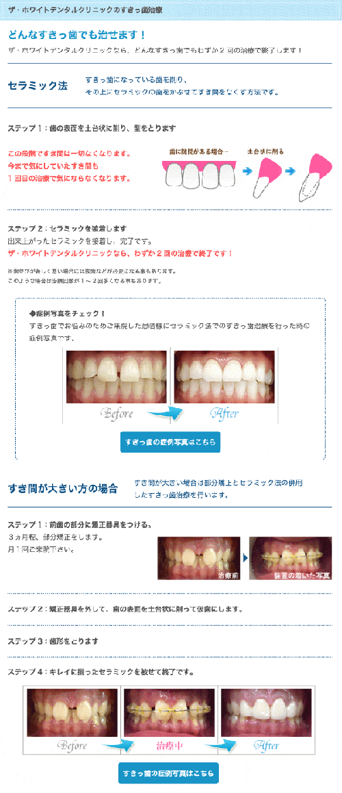 ザ・ホワイトデンタルクリニックのすきっ歯治療