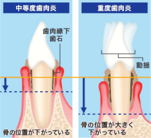 歯周病